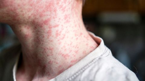 Leetrid levivad Baltikumis: näitus hoiatab unustatud haiguste naasmise eest